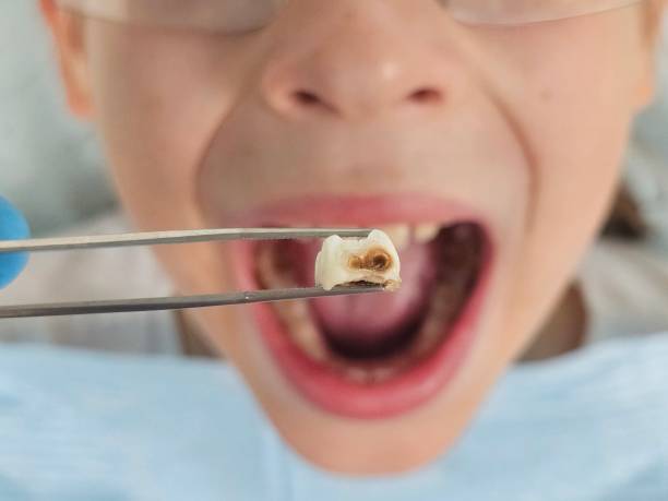 Best Emergency Wisdom Teeth Removal in Andover, MN